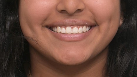 인비절라인 앞니 사이 공간 및 덧니 교정 관련 이미지 18