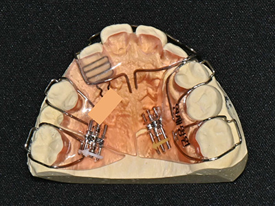 소아교정의 중요성 : 적절한 시기에 유치를 빼주는 것이 중요한 이유 @ 대치동 교정치과 연세정원치과 관련 이미지 11