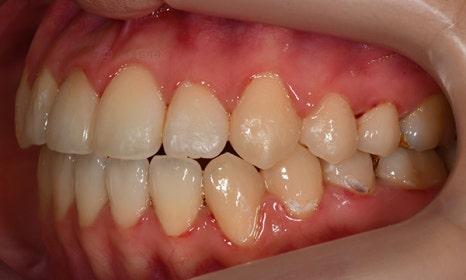 치아 중심선이 안 맞아요! 치아 비대칭 교정으로 가능할까요? @ 대치동 교정치과 연세정원치과 관련 이미지 12