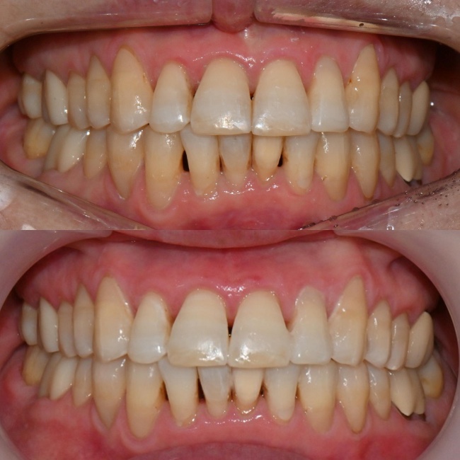 대치동 치경부 레진 & 중년교정 & 치아미백으로 자연스러운 미소를! 관련 이미지 20