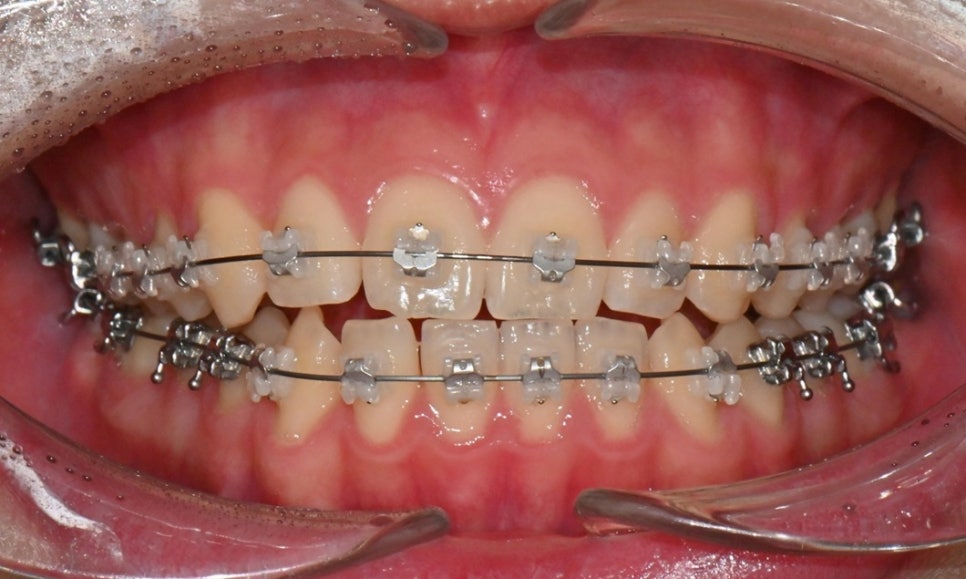치아 중심선 비대칭과 아랫입술 돌출 개선 관련 이미지 8