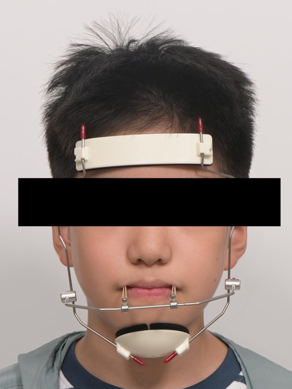 어린이 주걱턱 교정 - 페이스 마스크와 인비절라인 퍼스트 관련 이미지 7