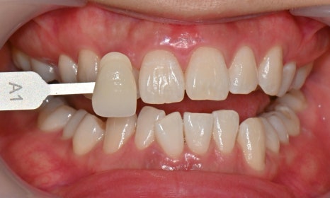 원데이 치아미백의 순서 @ 대치동 치아미백 연세정원치과의원 관련 이미지 16