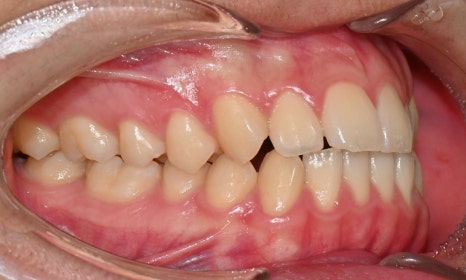 치아 중심선 비대칭과 아랫입술 돌출 개선 관련 이미지 4