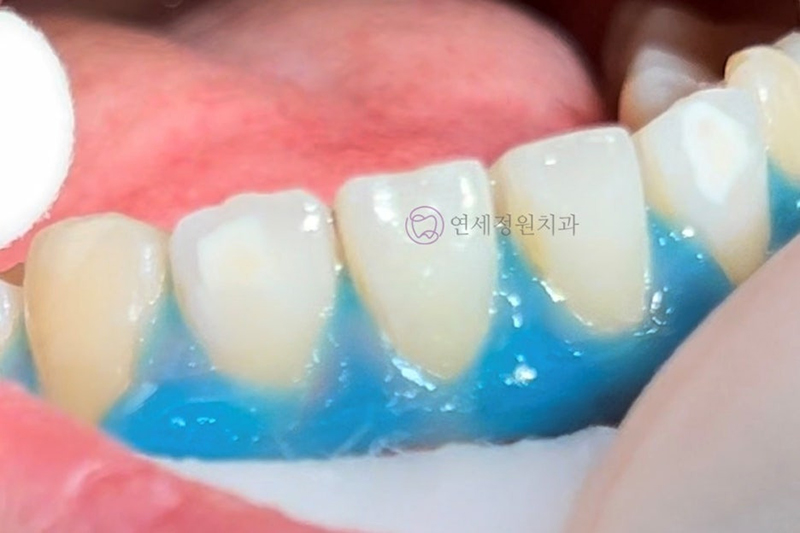 ICON Resin Treatment: White Spots on Front Teeth - Are They Cavities? 관련 이미지 6