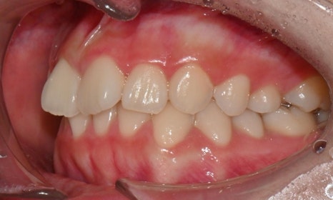 고등학생 인비절라인 교정｜앞니 치아배열 &middot; 과개교합 관련 이미지 4