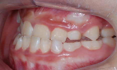 어린이 주걱턱 교정 - 페이스 마스크와 인비절라인 퍼스트 관련 이미지 3