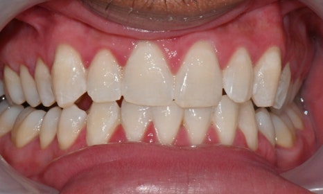 Invisalign Transfers for Immigration, Studying Abroad, Relocation, and More — International Students and Military Personnel image 8