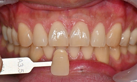 원데이 치아미백 @ 대치동치과 연세정원치과 관련 이미지 2