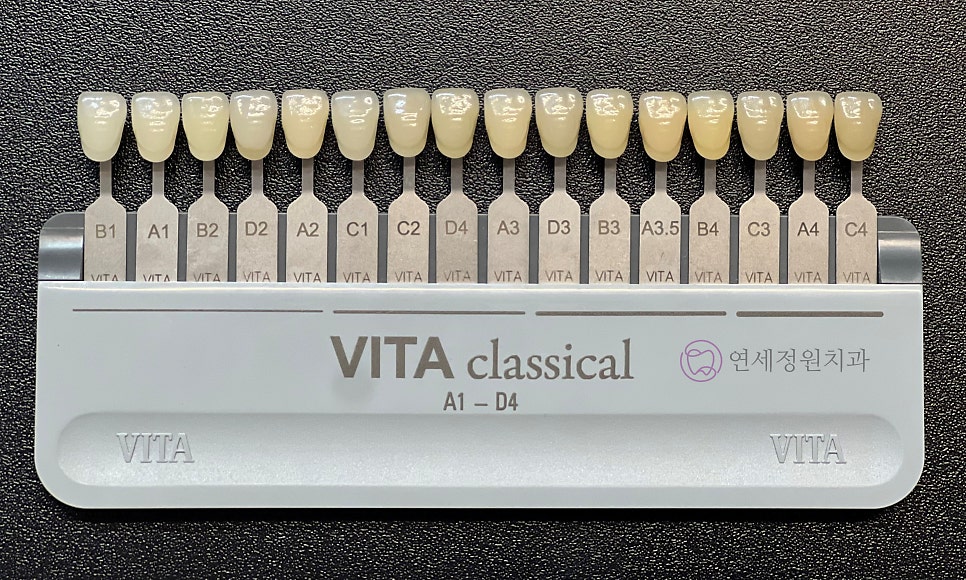 원데이 치아미백 - 앞니 크라운 사례 관련 이미지 5