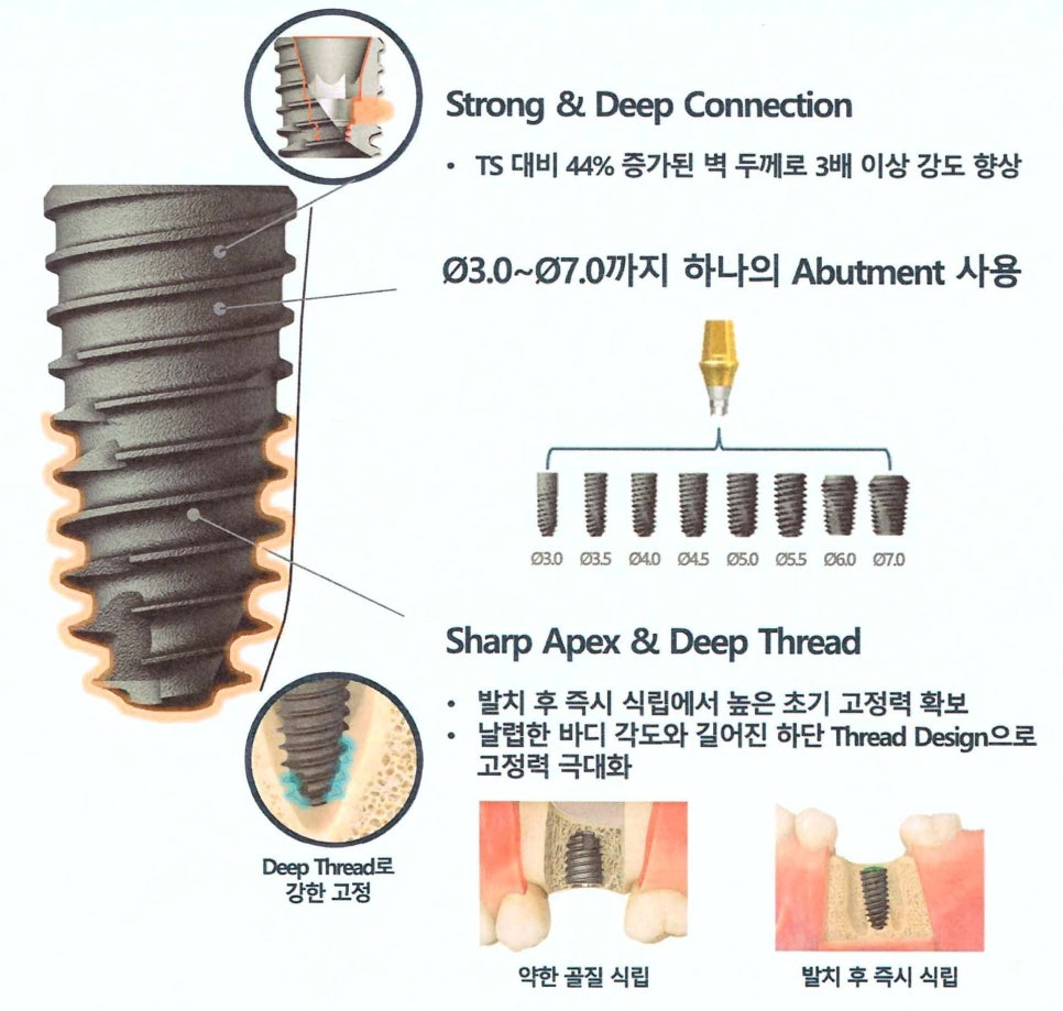 새롭게 출시된 오스템 임플란트 KS 시스템, 무엇이 달라졌을까요? 관련 이미지 2