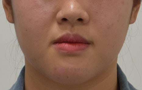 치아 중심선 비대칭 및 개방교합 교정, 대치동 연세정원치과 관련 이미지 5