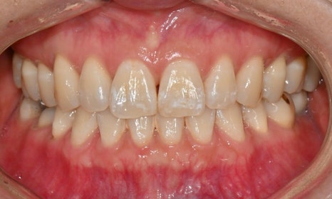 교정 치료 후 치아 미백 관련 이미지 9