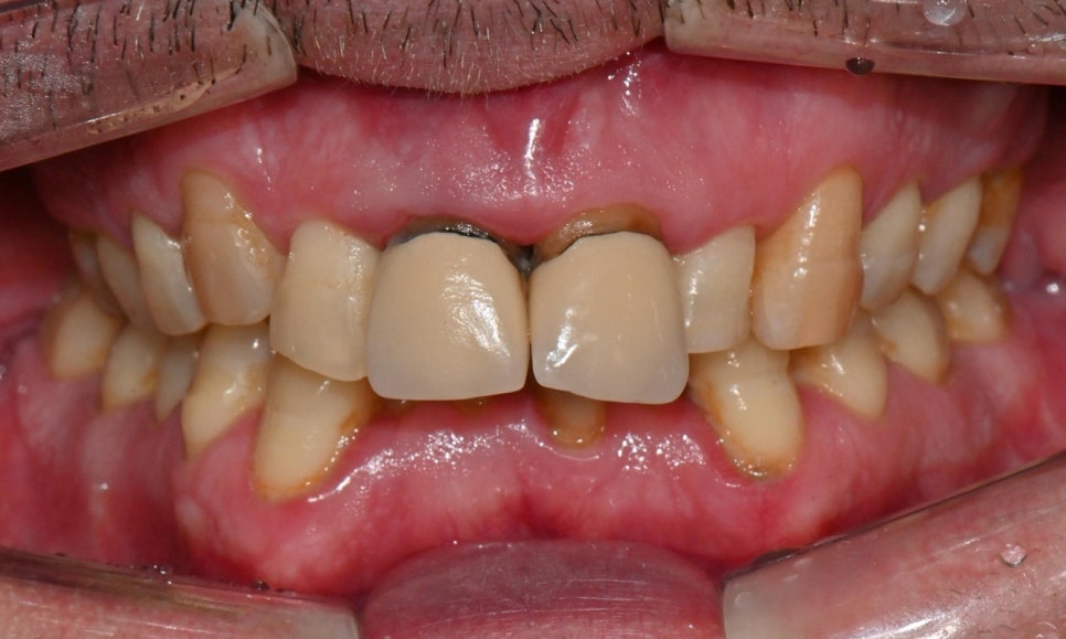 과개교합과 손상된 앞니, 심미와 기능을 함께 회복한 앞니 심미보철 케이스 관련 이미지 3