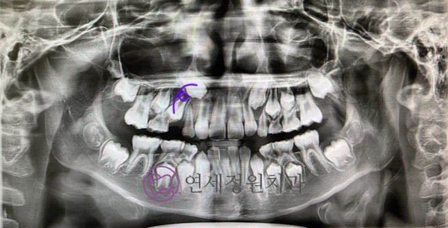 소아교정의 중요성 : 적절한 시기에 유치를 빼주는 것이 중요한 이유 @ 대치동 교정치과 연세정원치과 관련 이미지 7