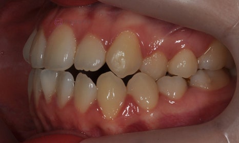 치아 중심선이 안 맞아요! 치아 비대칭 교정으로 가능할까요? @ 대치동 교정치과 연세정원치과 관련 이미지 7