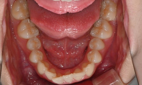 고등학생 인비절라인 교정｜앞니 치아배열 &middot; 과개교합 관련 이미지 6