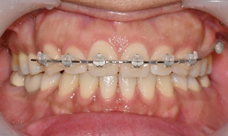 앞니 벌어짐 부분교정 (재교정) 관련 이미지 7