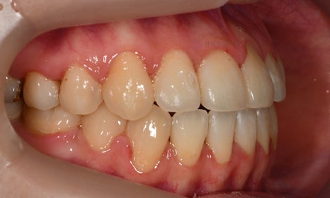 치아 중심선이 안 맞아요! 치아 비대칭 교정으로 가능할까요? @ 대치동 교정치과 연세정원치과 관련 이미지 11