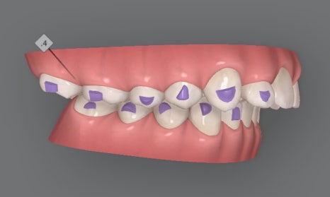 성장기 무턱교정 인비절라인 MA(mandibular advancment) 관련 이미지 7