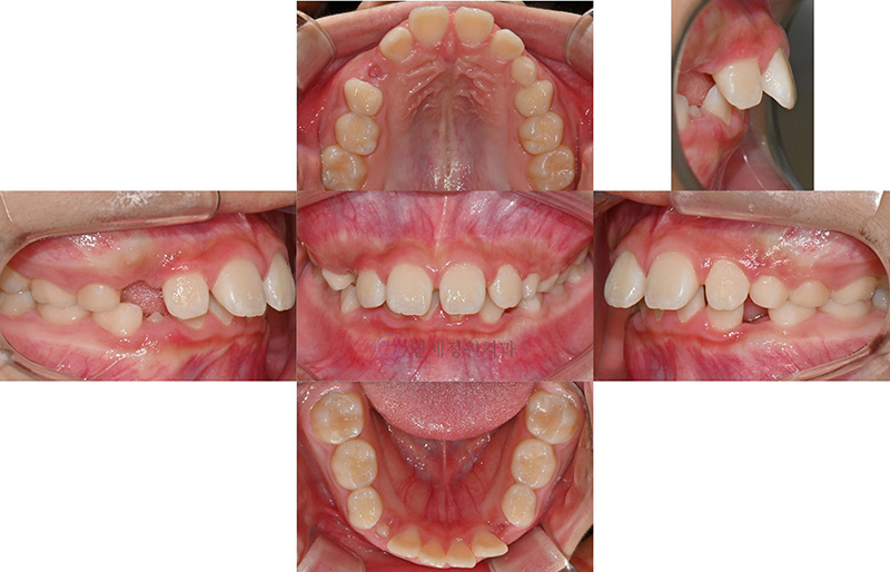 대치동교정치과, 무턱 성장교정과 엑티베이터 관련 이미지 2
