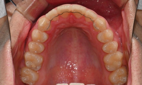 치아 중심선 비대칭과 아랫입술 돌출 개선 관련 이미지 21