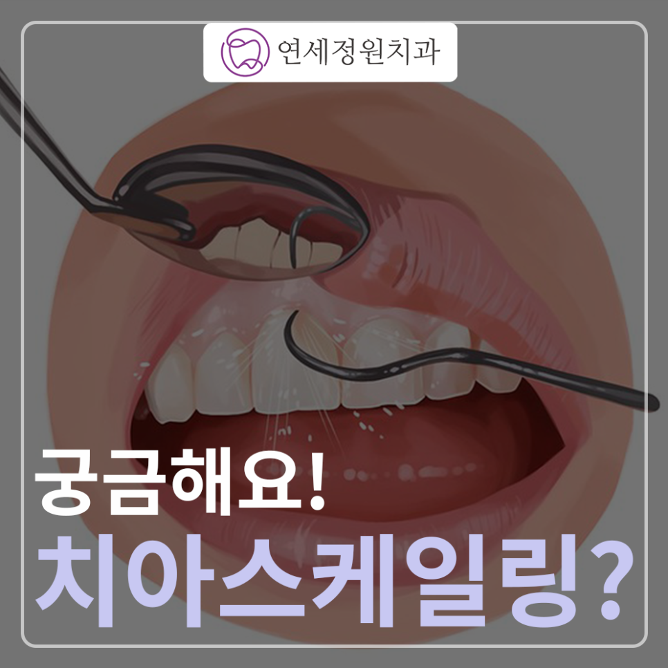 치아 스케일링 대치동 치과추천 관련 이미지 1