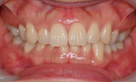 원데이 치아미백의 순서 @ 대치동 치아미백 연세정원치과의원 관련 이미지 19