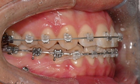 치아 중심선 비대칭과 아랫입술 돌출 개선 관련 이미지 14
