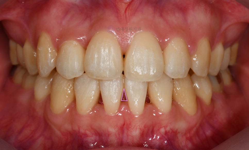 앞니 심미 레진 치료 : 블랙트라이앵글, 앞니 사이 공간 @ 대치동 연세정원치과 관련 이미지 7