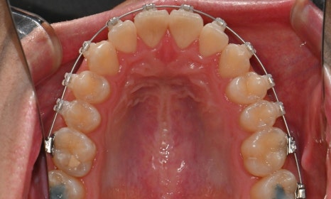 치아 중심선 비대칭과 아랫입술 돌출 개선 관련 이미지 16