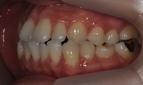 치아 중심선이 안 맞아요! 치아 비대칭 교정으로 가능할까요? @ 대치동 교정치과 연세정원치과 관련 이미지 17