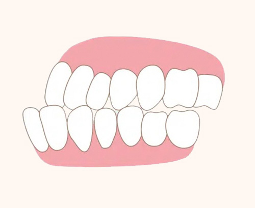 유학생 치아교정, 인비절라인 연세정원치과 관련 이미지 2