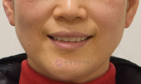 중년의 치아교정 시 고려할 사항, 대치동 연세정원치과 관련 이미지 4