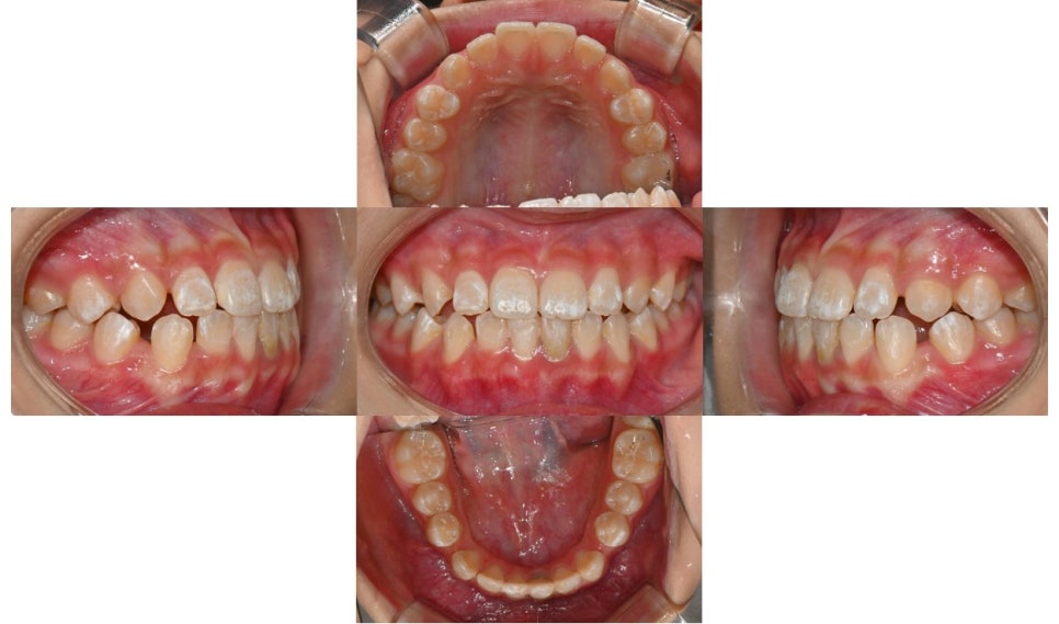 Why Is a Second Phase of Orthodontic Treatment Needed After the First? – A Case of Invisalign Treatment for a Growing Patient with Anterior Crossbite image 3