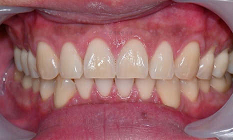 Teeth Whitening Case : A couple from the Netherlands 관련 이미지 5