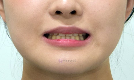 비수술 주걱턱 교정, 대치동 교정치과 연세정원치과 관련 이미지 7