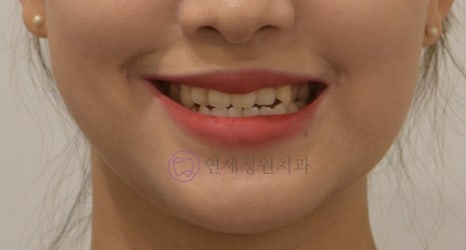치아 중심선이 안 맞아요! 치아 비대칭 교정으로 가능할까요? @ 대치동 교정치과 연세정원치과 관련 이미지 10
