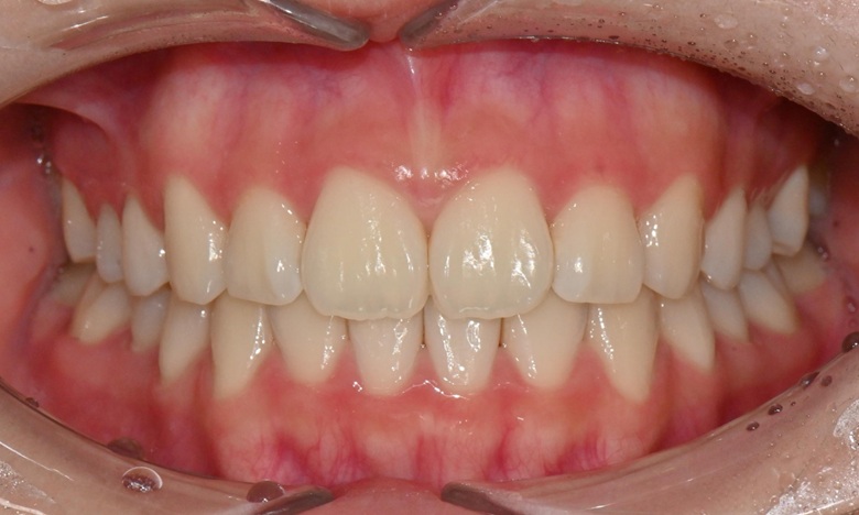 고등학생 인비절라인 교정｜앞니 치아배열 &middot; 과개교합 관련 이미지 17