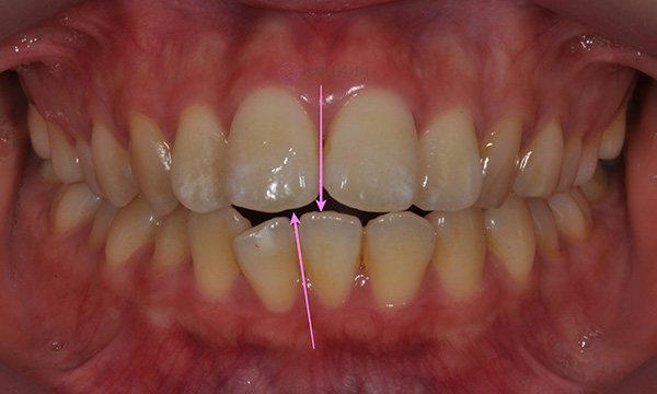 앞니가 안 물려요! 개방교합(openbite) 치아교정 전후 및 후기 관련 이미지 4