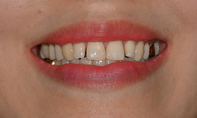 왜소치 치료 - 라미네이트 vs 레진비니어 vs 치아교정 관련 이미지 14