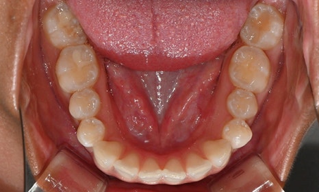 인비절라인 앞니 사이 공간 및 덧니 교정 관련 이미지 6