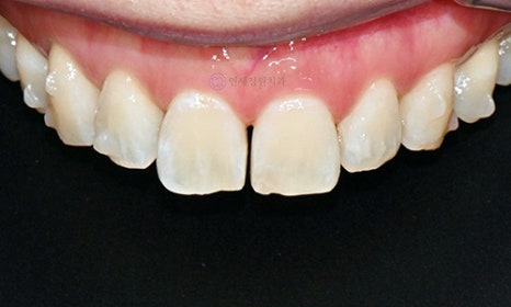 White Spot on My Front Tooth: Cavity or White Spot Lesion? 관련 이미지 10