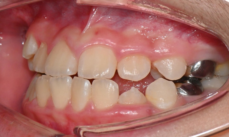 어린이 주걱턱 교정 - 페이스 마스크와 인비절라인 퍼스트 관련 이미지 4