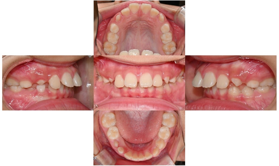 어린이 무턱 액티베이터 성장교정 후 인비절라인 퍼스트 관련 이미지 3