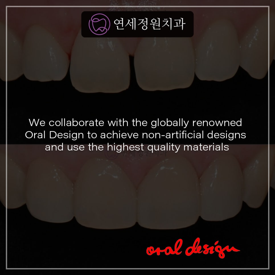 No-prep veneers in Korea: Pros and Cons&ndash; Yonsei JW Dental Clinic 관련 이미지 2