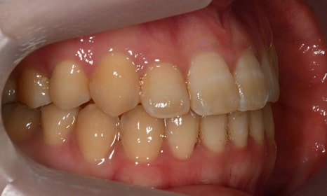 치아 중심선이 안 맞아요! 치아 비대칭 교정으로 가능할까요? @ 대치동 교정치과 연세정원치과 관련 이미지 27