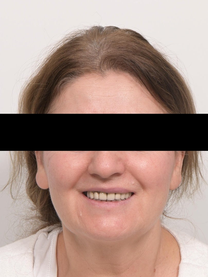 심미와 기능을 모두 고려한 앞니 심미보철 재치료 관련 이미지 6