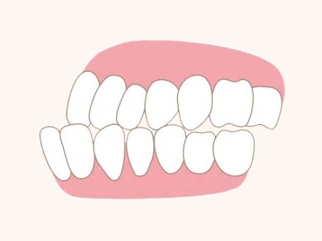 어린이 주걱턱 교정 - 페이스 마스크와 인비절라인 퍼스트 관련 이미지 2