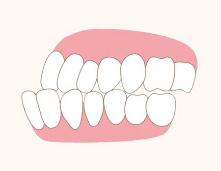 어린이 치아교정 해야 될까요? 대치동 교정치과 관련 이미지 2
